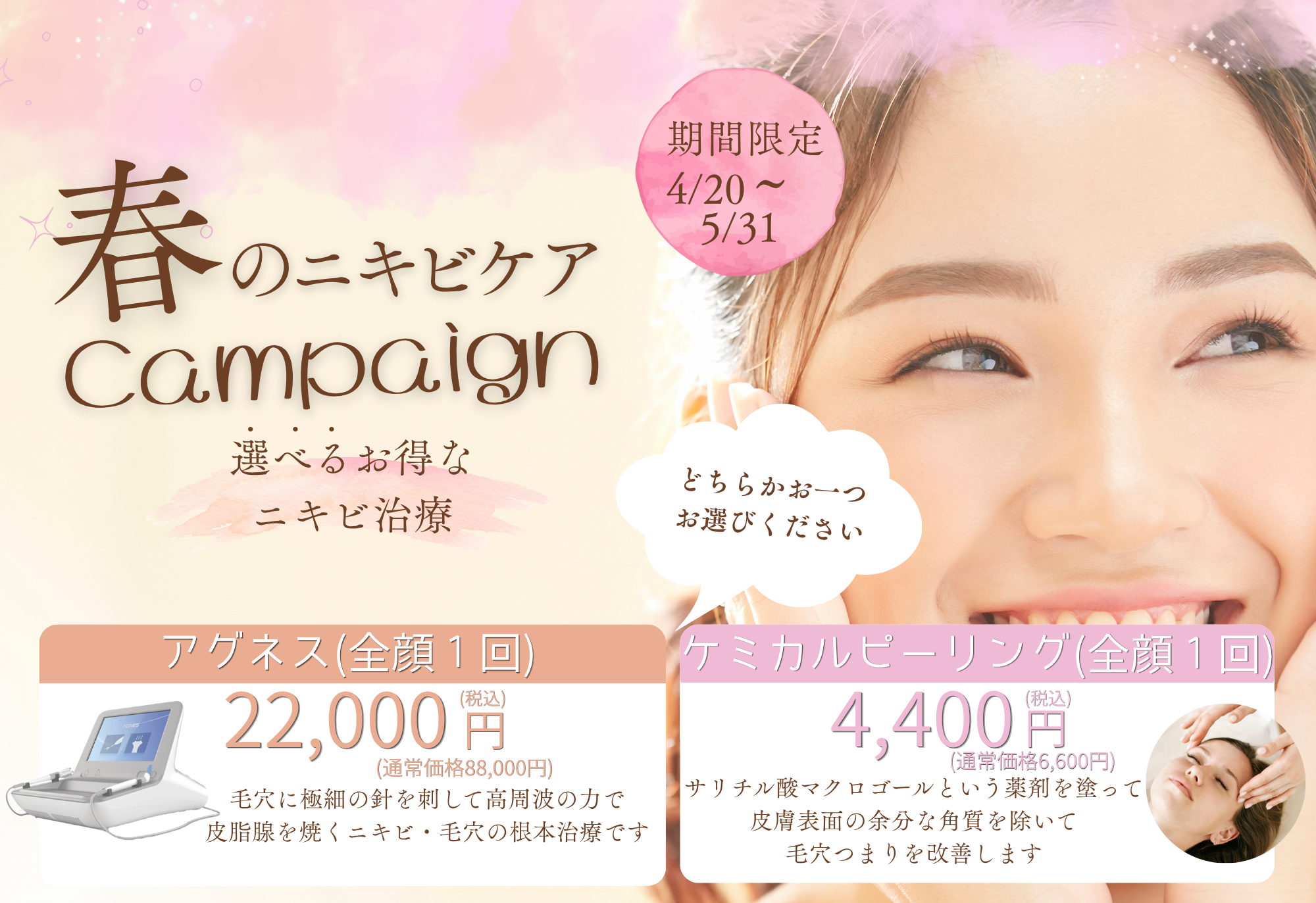 春のニキビケアキャンペーン